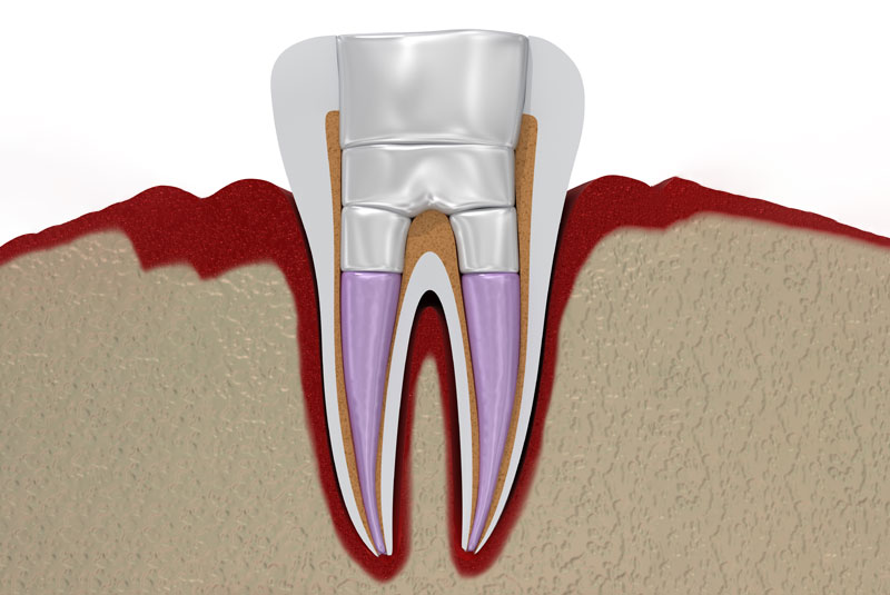 endodontic treatment 3d model