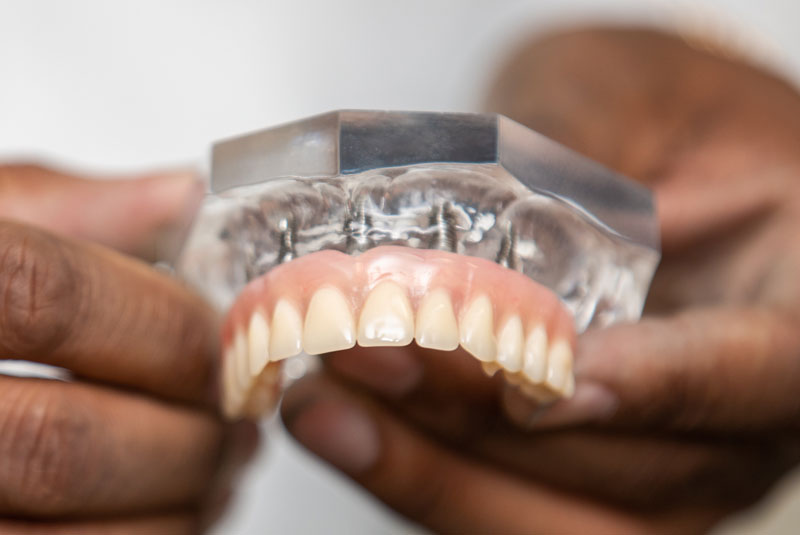full mouth dental implant model being held by dentist
