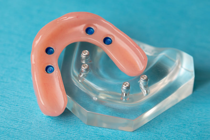 implant supported denture sitting on counter