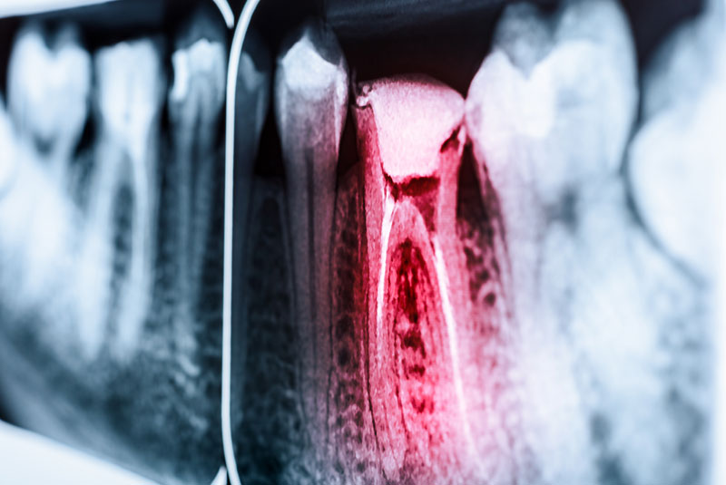 root canal xray 1